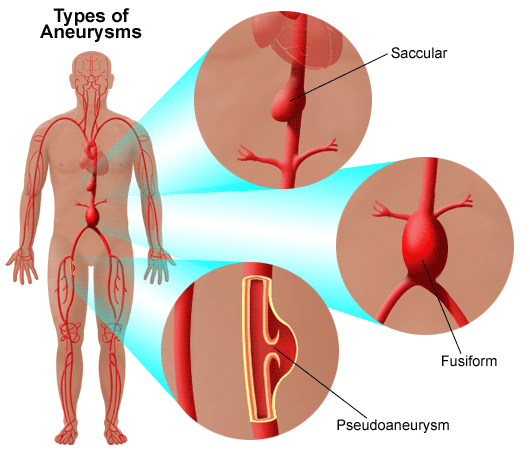 Aortic Aneurysm Causes Symptoms And Treatment
